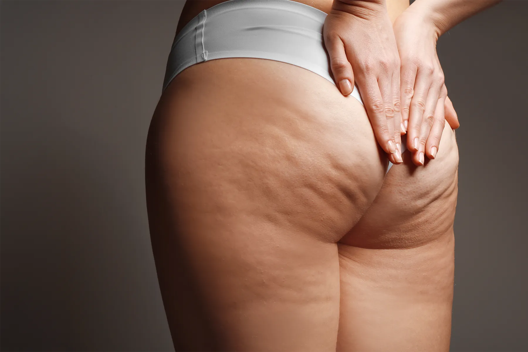 Faire fondre la cellulite à Lyon