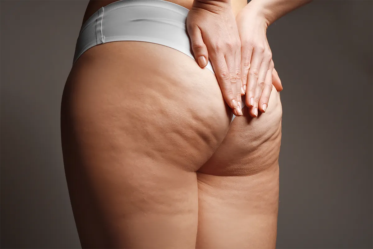 Faire fondre la cellulite à Lyon